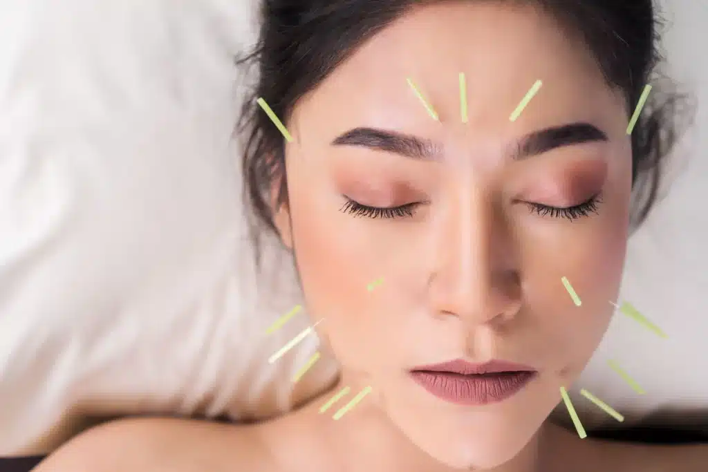 fertility acupuncture