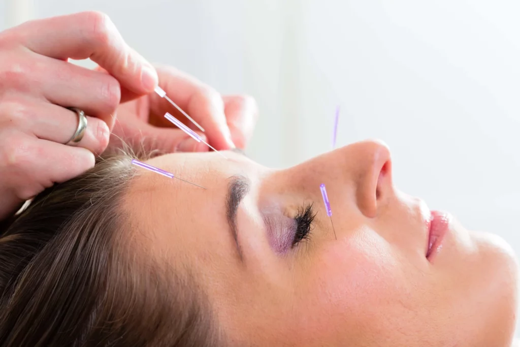 how much should acupuncture cost