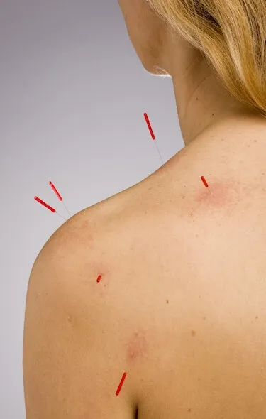 acupuncture clinic newport beach
