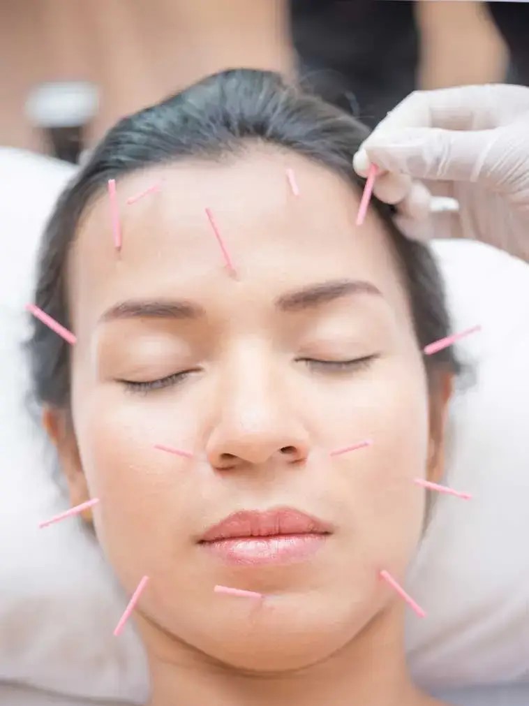 best acupuncture newport beach