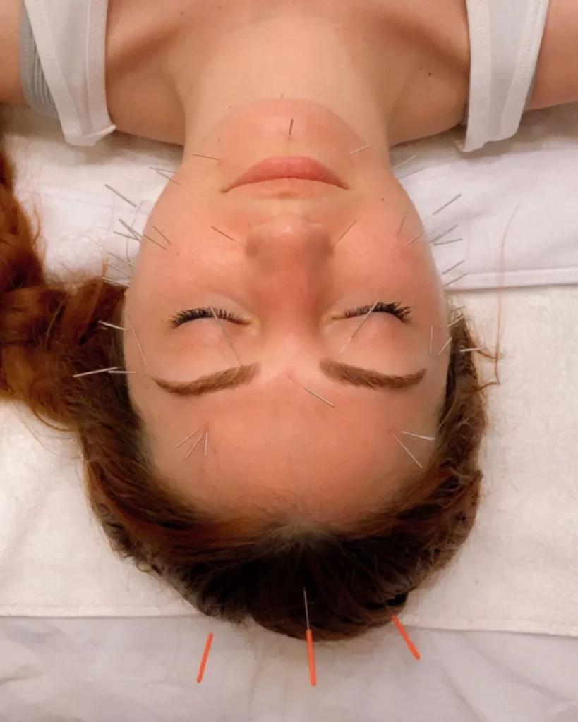 cosmetic acupuncture in newport beach