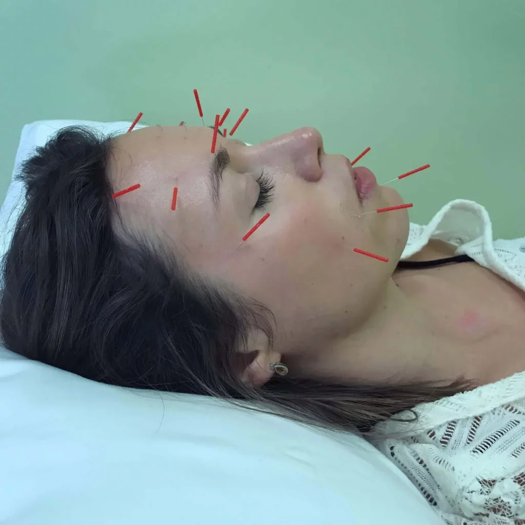 cosmetic acupuncture newport beach