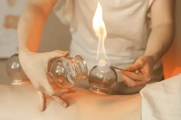 Fire cupping