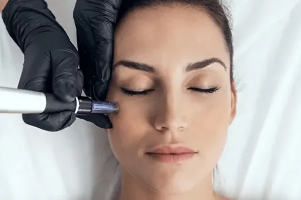 Microneedling