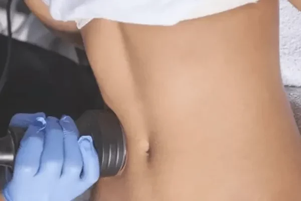 ultrasound cavitation